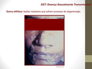 DST: Doença Sexualmente Transmissível
Goma sifilítica: lesões nodulares que sofrem processo de degeneração.
Arquivo do autor
 