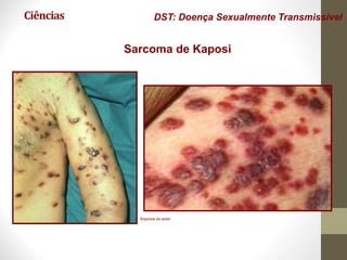 Ciências DST: Doença Sexualmente Transmissível
Sarcoma de Kaposi
Arquivos do autor
 