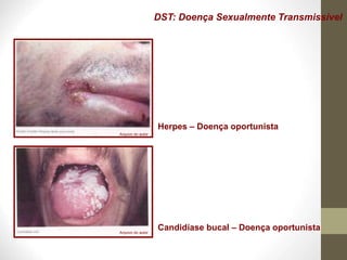 DST: Doença Sexualmente Transmissível
Herpes – Doença oportunista
Candidíase bucal – Doença oportunista
Arquivo do autor
Arquivo do autor
 
