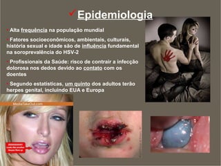 Epidemiologia
• Alta frequência na população mundial
• Fatores socioeconômicos, ambientais, culturais,
história sexual e idade são de influência fundamental
na soroprevalência do HSV-2
• Profissionais da Saúde: risco de contrair a infecção
dolorosa nos dedos devido ao contato com os
doentes
• Segundo estatísticas, um quinto dos adultos terão
herpes genital, incluindo EUA e Europa
 