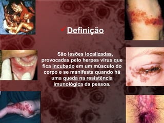 Definição

        São lesões localizadas,
provocadas pelo herpes vírus que
fica incubado em um músculo do
 corpo e se manifesta quando há
    uma queda na resistência
      imunológica da pessoa.
 
