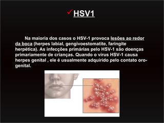 HSV1

    Na maioria dos casos o HSV-1 provoca lesões ao redor
da boca (herpes labial, gengivoestomatite, faringite
herpética). As infecções primárias pelo HSV-1 são doenças
primariamente de crianças. Quando o vírus HSV-1 causa
herpes genital , ele é usualmente adquirido pelo contato oro-
genital.
 