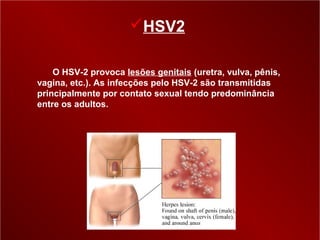 HSV2

    O HSV-2 provoca lesões genitais (uretra, vulva, pênis,
vagina, etc.). As infecções pelo HSV-2 são transmitidas
principalmente por contato sexual tendo predominância
entre os adultos.
 