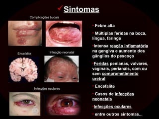 Sintomas
        Complicações bucais

                                           • Febre alta
                                           • Múltiplas feridas na boca,
                                           língua, faringe
                                           •Intensa reação inflamatória
                       Infecção neonatal   na gengiva e aumento dos
Encefalite
                                           gânglios do pescoço
                                           •Feridas penianas, vulvares,
                                           vaginais, perianais, com ou
                                           sem comprometimento
                                           uretral
                                           • Encefalite
             Infecções oculares
                                           • Casos de infecções
                                           neonatais
                                           •Infecções oculares
                                           • entre outros sintomas...
 