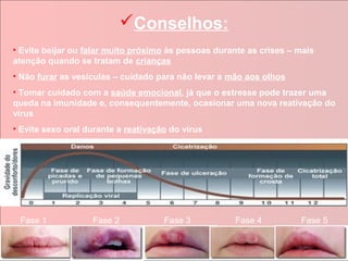 Conselhos:
• Evite beijar ou falar muito próximo às pessoas durante as crises – mais
atenção quando se tratam de crianças
• Não furar as vesículas – cuidado para não levar a mão aos olhos
• Tomar cuidado com a saúde emocional, já que o estresse pode trazer uma
queda na imunidade e, consequentemente, ocasionar uma nova reativação do
vírus
• Evite sexo oral durante a reativação do vírus




 Fase 1            Fase 2            Fase 3          Fase 4          Fase 5
 