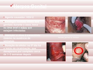 Herpes Genital
                                    Herpes genital na mulher

• Agente causador: HSV-2
• Contágio: contato íntimo dos
genitais durante o sexo, boca
ou área anal e mãos que
estejam infectadas
• Atenção: o vírus é transmitido
mesmo na ausência de                Herpes genital no homem

sintomas
• Duração do efeito: no 5º dia há
o início da cicatrização, que
desaparece por completo cerca
de 1~3 semanas depois
 