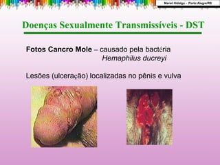 Fotos Cancro Mole  –   causado pela bact é ria  Hemaphilus ducreyi Lesões (ulcera ç ão) localizadas no pênis e vulva Doenças Sexualmente Transmissíveis - DST  Mariel Hidalgo -  Porto Alegre/RS 