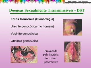 Doenças Sexualmente Transmissíveis - DST  Fotos Gonorréia (Blenorragia) Uretrite gonoc ó cica (no homem)  Vaginite gonoc ó cica Oftalmia gonoc ó cica Mariel Hidalgo -  Porto Alegre/RS Provocada pela bactéria  Neisseria gonorrheae 