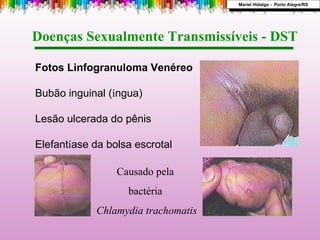 Doenças Sexualmente Transmissíveis - DST  Fotos Linfogranuloma Venéreo Bubão inguinal ( í ngua) Lesão ulcerada do pênis Elefant í ase da bolsa escrotal   Mariel Hidalgo -  Porto Alegre/RS Causado pela  bactéria  Chlamydia trachomatis 