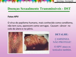 Fotos HPV O vírus do papiloma humano, mais conhecido como condiloma, não tem cura, aparecem como verrugas.  Causam  câncer  no colo do útero e no pênis. Doenças Sexualmente Transmissíveis - DST  DETALHE:   CAMISINHA NÃO PROTEGE! O HPV ataca os testículos também. Mariel Hidalgo -  Porto Alegre/RS 