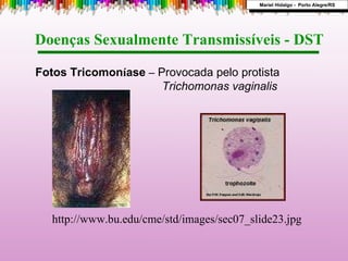 http://www.bu.edu/cme/std/images/sec07_slide23.jpg  Fotos Tricomon í ase  –   Provocada pelo protista Trichomonas vaginalis   Doenças Sexualmente Transmissíveis - DST  Mariel Hidalgo -  Porto Alegre/RS 