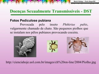 http://cienciahoje.uol.com.br/images/ch%20on-line/2004/Piolho.jpg Fotos Pediculose pubiana Provocada pelo inseto  Phthirius pubis , vulgarmente chamado de chato. São pequenos piolhos que se instalam nos pêlos pubianos provocando coceira. Doenças Sexualmente Transmissíveis - DST  Mariel Hidalgo -  Porto Alegre/RS 