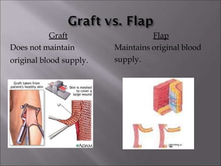 Graft
Does not maintain
original blood supply.
Flap
Maintains original blood
supply.
 