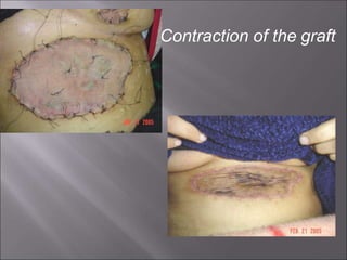 Contraction of the graft
 