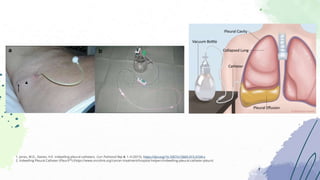 1. Jones, W.D., Davies, H.E. Indwelling pleural catheters. Curr Pulmonol Rep 4, 1–9 (2015). https://doi.org/10.1007/s13665-015-0104-x
2. Indwelling Pleural Catheter (PleurX™) (https://www.oncolink.org/cancer-treatment/hospital-helpers/indwelling-pleural-catheter-pleurx)
 