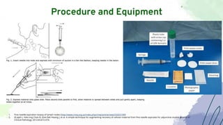 Procedure and Equipment
1. Fine-needle aspiration biopsy of lymph nodes (http://www.cmej.org.za/index.php/cmej/article/view/2333/2189)
2. Al Jajeh I, Hok-Ling Chan N, Siok-Gek Hwang J, et al. A simple technique for augmenting recovery of cellular material from fine needle aspirates for adjunctive studies Journal of
Clinical Pathology 2012;65:672-674.
 