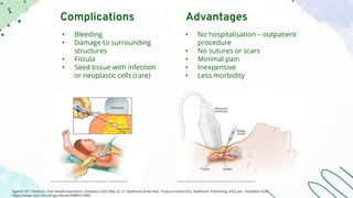 • Bleeding
• Damage to surrounding
structures
• Fistula
• Seed tissue with infection
or neoplastic cells (rare)
• No hospitalisation – outpatient
procedure
• No sutures or scars
• Minimal pain
• Inexpensive
• Less morbidity
Advantages
Complications
Sigmon DF, Fatima S. Fine Needle Aspiration. [Updated 2022 May 2]. In: StatPearls [Internet]. Treasure Island (FL): StatPearls Publishing; 2022 Jan-. Available from:
https://www.ncbi.nlm.nih.gov/books/NBK557486/
 