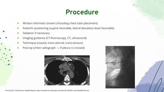 ● Written informed consent (including chest tube placement)
● Patient’s positioning (supine favorable, lateral decubitus least favorable)
● Sedation if necessary
● Imaging guidance (CT-fluoroscopy, CT, ultrasound)
● Technique (coaxial, trans-sternal, trans-venous)
● Post-op (chest radiograph → if pleura is crossed)
Procedure
Thomas JW. Transthoracic Needle Biopsy. https://emedicine.medscape.com/article/1822831-overview#a5Thomas
 
