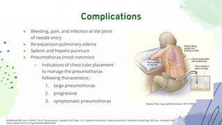 ● Bleeding, pain, and infection at the point
of needle entry
● Re-expansion pulmonary edema
● Splenic and hepatic puncture
● Pneumothorax (most common)
○ Indications of chest tube placement
to manage the pneumothorax
following thoracentesis :
1. large pneumothorax
2. progressive
3. symptomatic pneumothorax
Complications
Wiederhold BD, Amr O, Modi P, et al. Thoracentesis. [Updated 2022 May 1]. In: StatPearls [Internet]. Treasure Island (FL): StatPearls Publishing; 2022 Jan-. Available from:
https://www.ncbi.nlm.nih.gov/books/NBK441866/
National Heart, Lung and Blood Institute ( PD-US NIH)
 