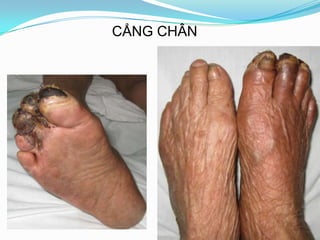 CẲNG CHÂN