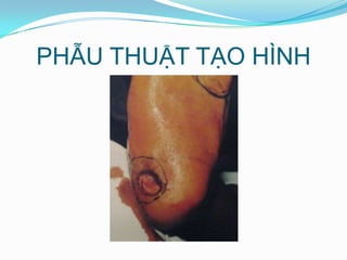 PHẪU THUẬT TẠO HÌNH