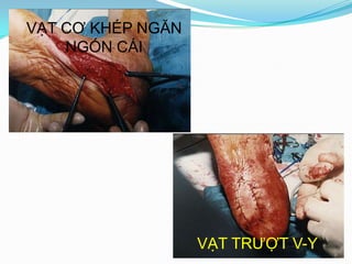 VẠT CƠ KHÉP NGĂN NGÓN CÁIVẠT TRƯỢT V-Y
