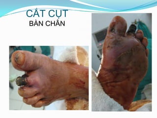 CẮT CỤTBÀN CHÂN
