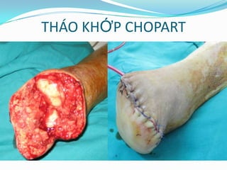 THÁO KHỚP CHOPART