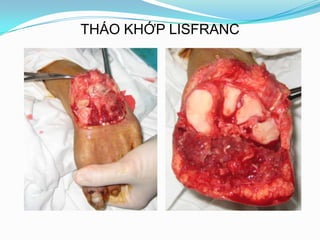 THÁO KHỚP LISFRANC
