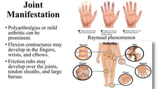 Joint
Manifestation
• Polyarthralgias or mild
arthritis can be
prominent.
• Flexion contractures may
develop in the fingers,
wrists, and elbows.
• Friction rubs may
develop over the joints,
tendon sheaths, and large
bursae.
Raynaud phenomenon
 