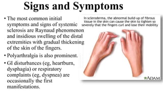 Signs and Symptoms
• The most common initial
symptoms and signs of systemic
sclerosis are Raynaud phenomenon
and insidious swelling of the distal
extremities with gradual thickening
of the skin of the fingers.
• Polyarthralgia is also prominent.
• GI disturbances (eg, heartburn,
dysphagia) or respiratory
complaints (eg, dyspnea) are
occasionally the first
manifestations.
 