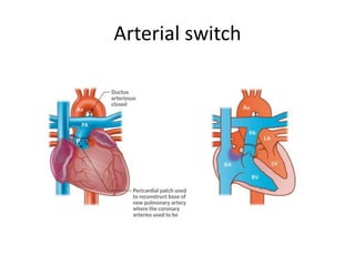 Arterial switch
 