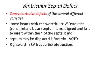 Ventricular Septal Defect
• Conoventricular defects of the several different
varieties
• some hearts with conoventricular VSDs=outlet
(conal, infundibular) septum is malaligned and fails
to insert within the Y of the septal band
• septum may be displaced leftward= LVOTO
• Rightward=n RV (subaortic) obstruction.
 