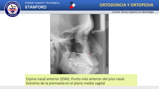 Espina nasal anterior (ENA): Punto más anterior del piso nasal.
Extremo de la premaxila en el plano medio sagital
ORTODONCIA Y ORTOPEDIA
Carrera: Técnico Superior en odontología
 