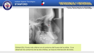 Orbital (Or): Punto más inferior en el contorno del hueso de la orbita. Si se
observan los contornos de las dos órbitas, se traza la intersección de estos.
ORTODONCIA Y ORTOPEDIA
Carrera: Técnico Superior en odontología
ORTODONCIA Y ORTOPEDIA
Carrera: Técnico Superior en odontología
 