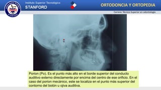 .
Porion (Po). Es el punto más alto en el borde superior del conducto
auditivo externo directamente por encima del centro de ese orificio. En el
caso del porion mecánico, este se localiza en el punto más superior del
contorno del botón u ojiva auditiva.
ORTODONCIA Y ORTOPEDIA
Carrera: Técnico Superior en odontología
 