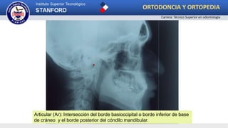 .
Articular (Ar): Intersección del borde basioccipital o borde inferior de base
de cráneo y el borde posterior del cóndilo mandibular.
ORTODONCIA Y ORTOPEDIA
Carrera: Técnico Superior en odontología
 