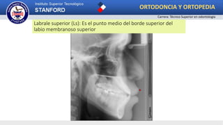 Labrale superior (Ls): Es el punto medio del borde superior del
labio membranoso superior
ORTODONCIA Y ORTOPEDIA
Carrera: Técnico Superior en odontología
 
