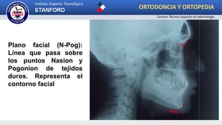 Plano S-N
N
Pog
Plano facial (N-Pog):
Línea que pasa sobre
los puntos Nasion y
Pogonion de tejidos
duros. Representa el
contorno facial
ORTODONCIA Y ORTOPEDIA
Carrera: Técnico Superior en odontología
 