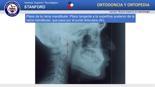 Plano S-N
Plano de la rama mandibular: Plano tangente a la superficie posterior de la
rama mandibular, que pasa por el punto Articulare (Ar).
ORTODONCIA Y ORTOPEDIA
Carrera: Técnico Superior en odontología
 