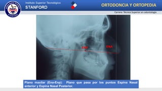 Plano S-N
ENAENP
Plano maxilar (Ena-Enp): Plano que pasa por los puntos Espina Nasal
anterior y Espina Nasal Posterior.
ORTODONCIA Y ORTOPEDIA
Carrera: Técnico Superior en odontología
 