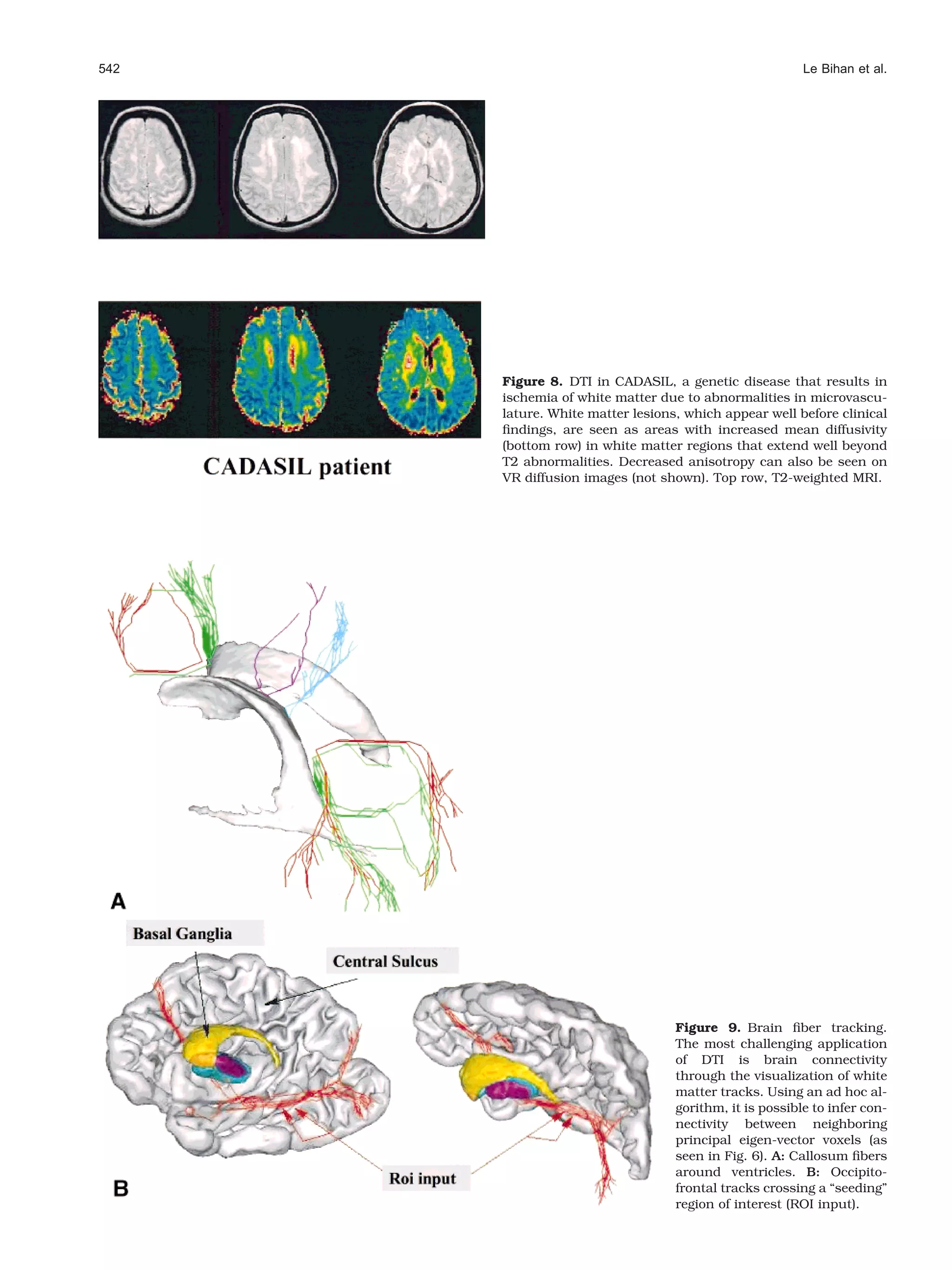 542                                                     Le Bihan et al.




      Figure 8. DTI in CADASIL, a genetic disease that results in
      ischemia of white matter due to abnormalities in microvascu-
      lature. White matter lesions, which appear well before clinical
      ﬁndings, are seen as areas with increased mean diffusivity
      (bottom row) in white matter regions that extend well beyond
      T2 abnormalities. Decreased anisotropy can also be seen on
      VR diffusion images (not shown). Top row, T2-weighted MRI.




                                  Figure 9. Brain ﬁber tracking.
                                  The most challenging application
                                  of DTI is brain connectivity
                                  through the visualization of white
                                  matter tracks. Using an ad hoc al-
                                  gorithm, it is possible to infer con-
                                  nectivity between neighboring
                                  principal eigen-vector voxels (as
                                  seen in Fig. 6). A: Callosum ﬁbers
                                  around ventricles. B: Occipito-
                                  frontal tracks crossing a “seeding”
                                  region of interest (ROI input).
 