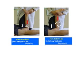 Teste da Moagem
(testa integridade dos
meniscos)
Teste da Distração
(testa integridade dos
ligamentos)
 