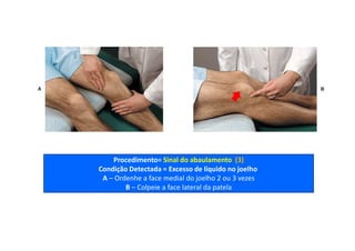 Procedimento= Sinal do abaulamento (3)
Condição Detectada = Excesso de líquido no joelho
A – Ordenhe a face medial do joelho 2 ou 3 vezes
B – Colpeie a face lateral da patela
 