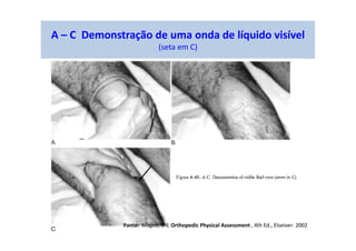 A – C Demonstração de uma onda de líquido visível
(seta em C)
Fonte: Magee, D J; Orthopedic Physical Assessment , 4th Ed., Elseiver- 2002
 