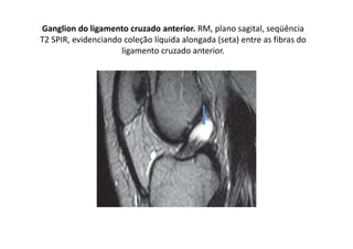 Ganglion do ligamento cruzado anterior. RM, plano sagital, seqüência
T2 SPIR, evidenciando coleção líquida alongada (seta) entre as fibras do
ligamento cruzado anterior.
 