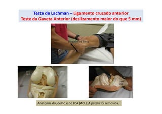 Teste de Lachman – Ligamento cruzado anterior
Teste da Gaveta Anterior (deslizamento maior do que 5 mm)
Anatomia do joelho e do LCA (ACL). A patela foi removida.
 
