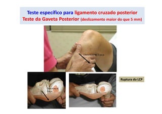 Teste específico para ligamento cruzado posterior
Teste da Gaveta Posterior (deslizamento maior do que 5 mm)
Ruptura do LCP
 
