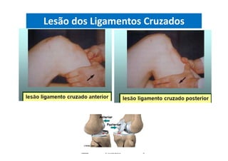 Lesão dos Ligamentos Cruzados
 