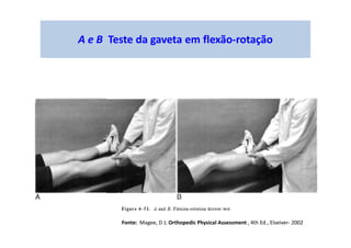 A e B Teste da gaveta em flexão-rotação
Fonte: Magee, D J; Orthopedic Physical Assessment , 4th Ed., Elseiver- 2002
 